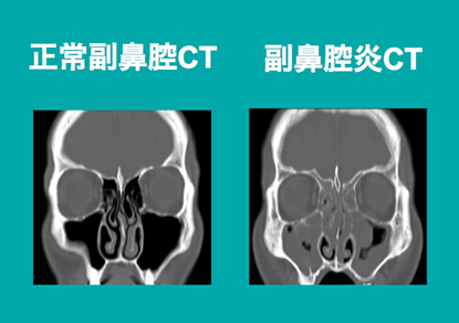 副鼻腔CT