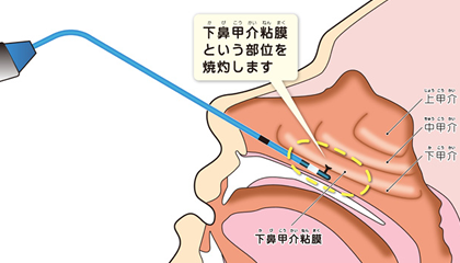 レーザー治療とは