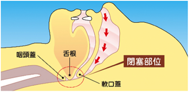 SAS患者さんの気道閉塞